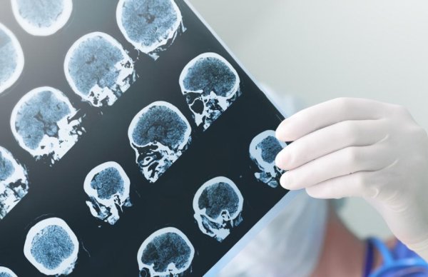 真牛所配资 全疗程费用超36万元！谁在使用阿尔茨海默病药物？安全性如何？